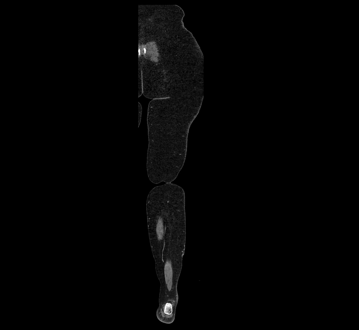 CTA lower limb coronal cross sectional anatomy labelled image _84 (2).webp